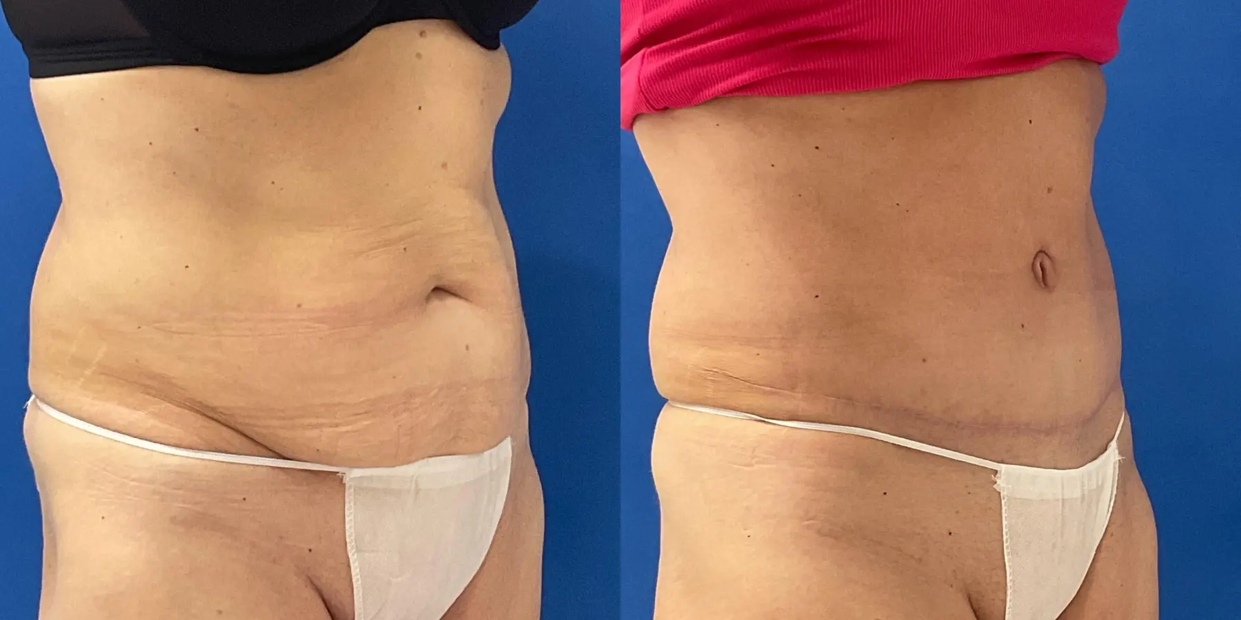 Tummy Tuck: Patient 27 - Before and After 3