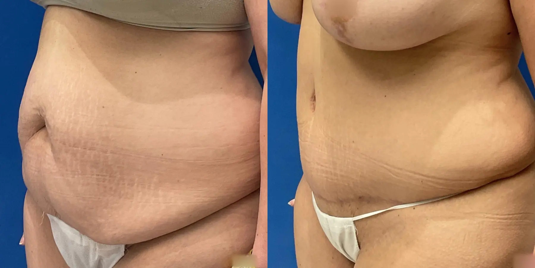 Tummy Tuck: Patient 6 - Before and After 2