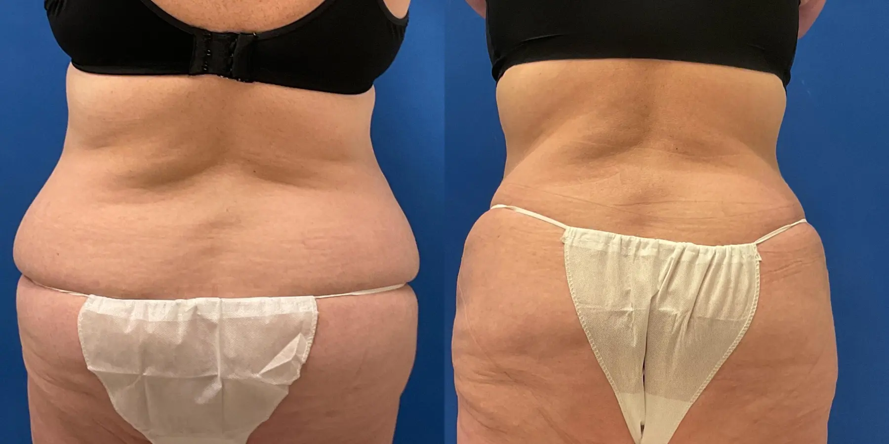 Tummy Tuck: Patient 1 - Before and After 6