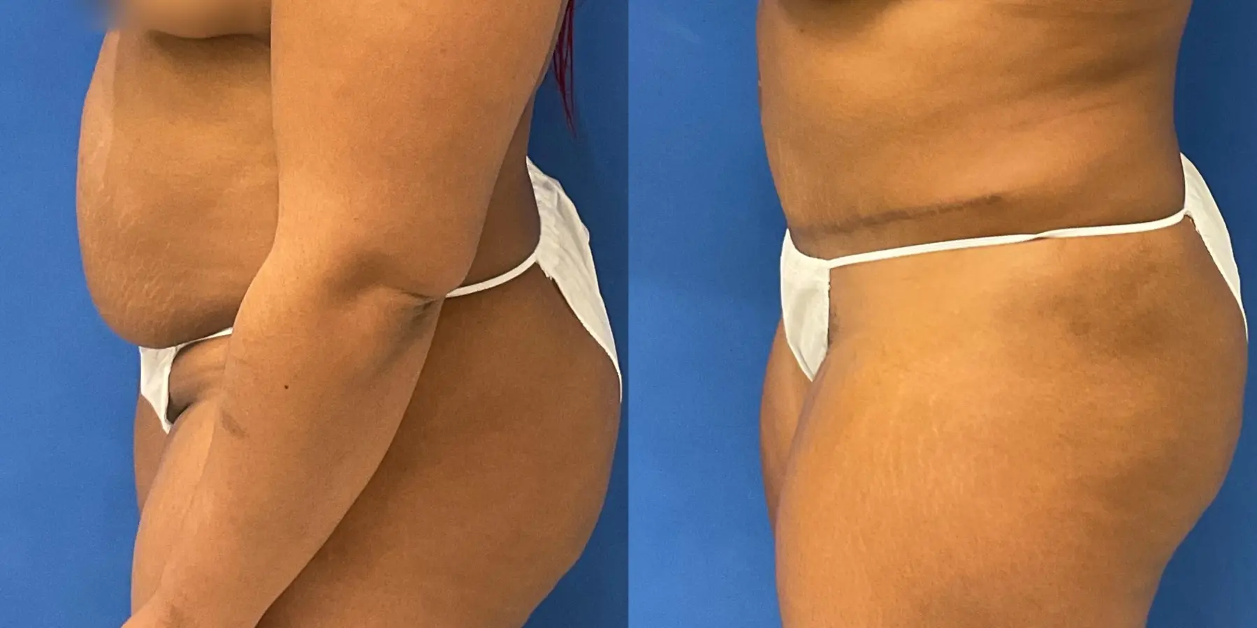 Tummy Tuck: Patient 2 - Before and After 4