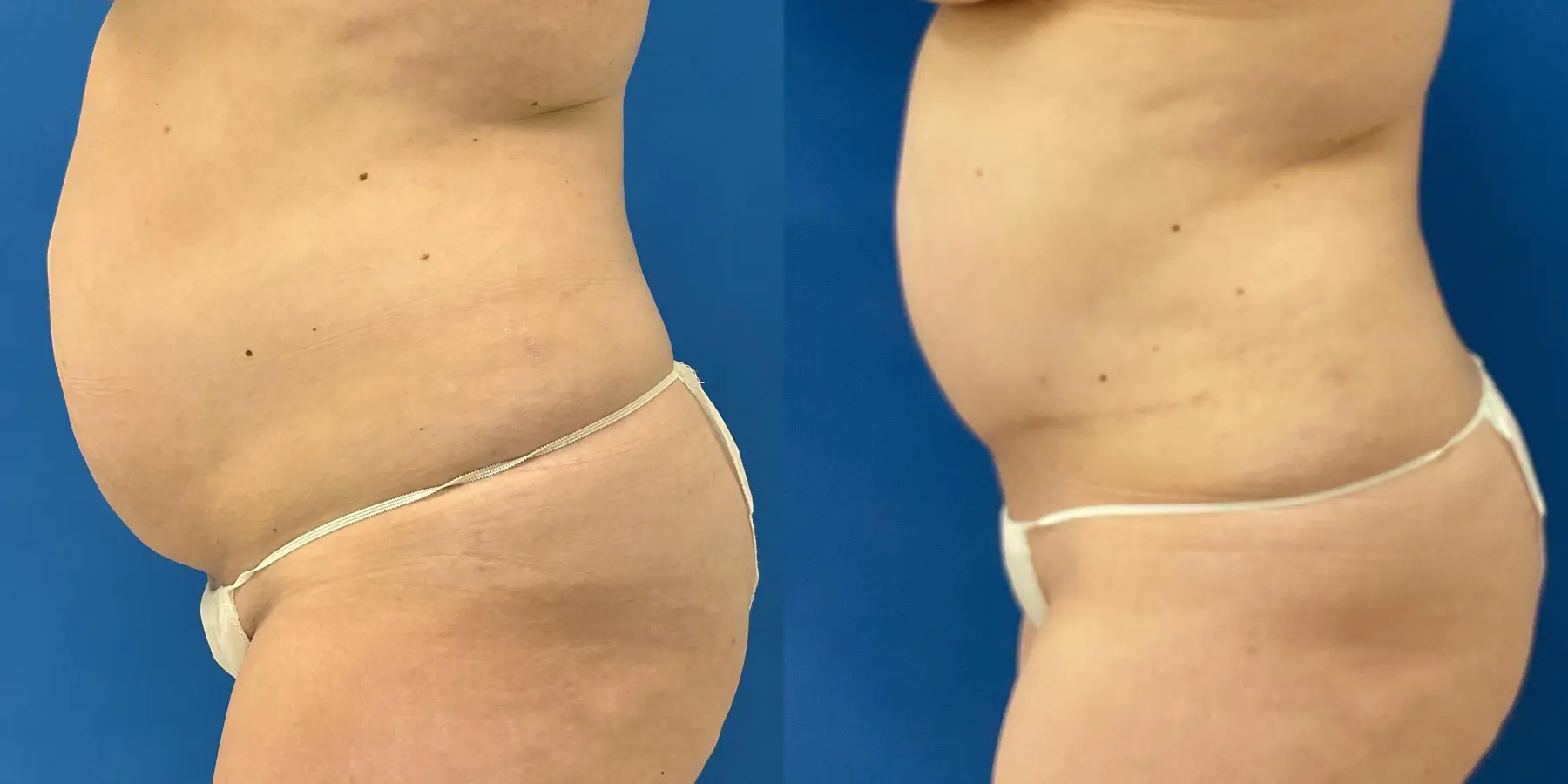 Tummy Tuck: Patient 4 - Before and After 4