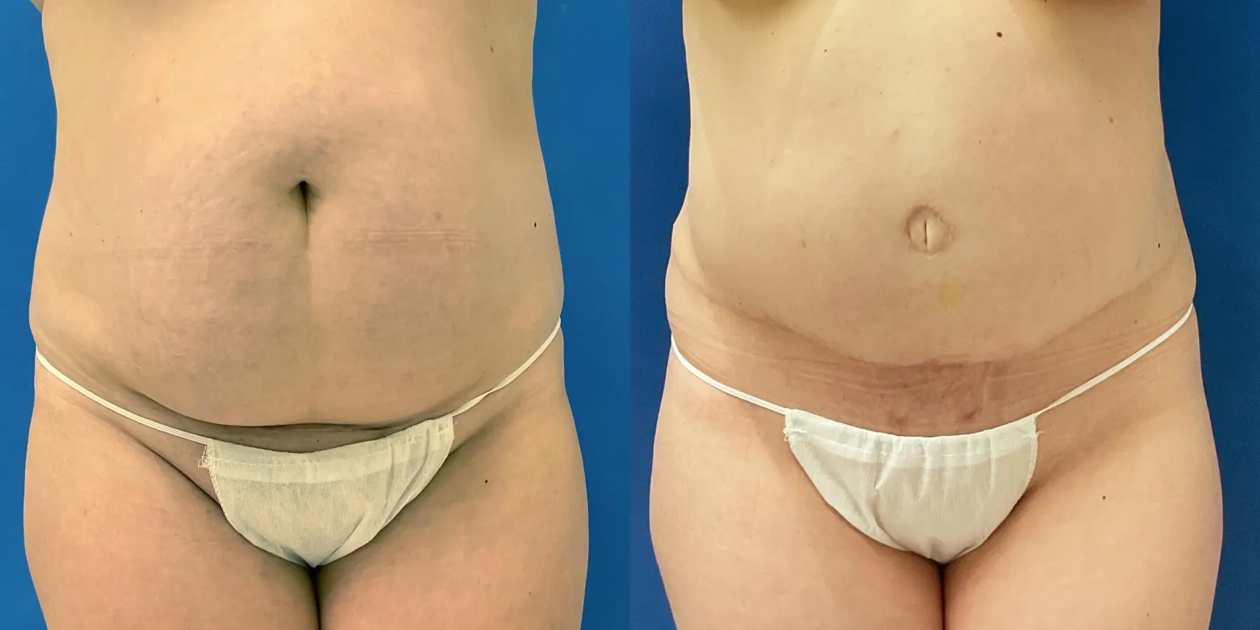 Tummy Tuck: Patient 4 - Before and After  