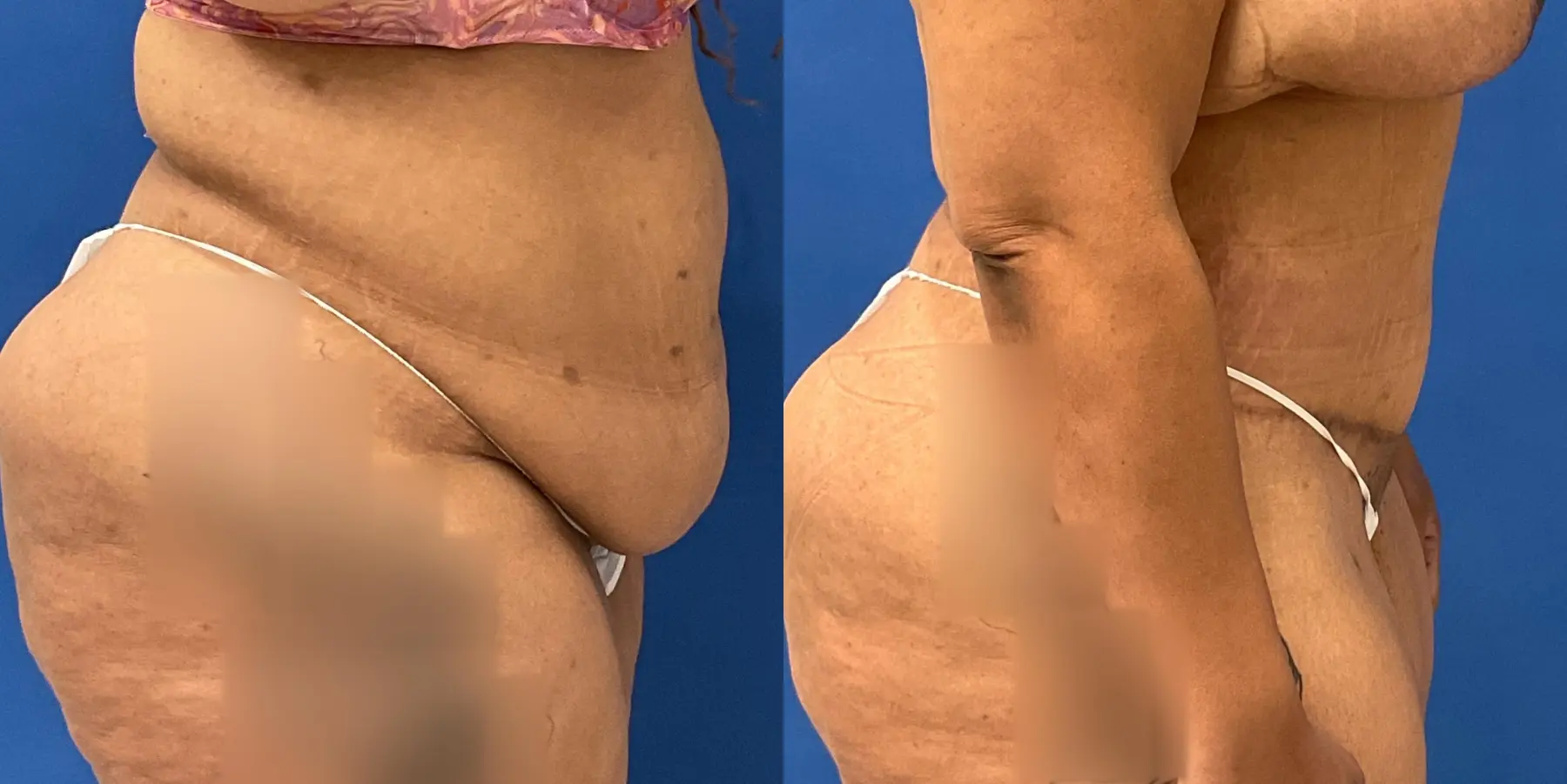 Tummy Tuck: Patient 7 - Before and After 5