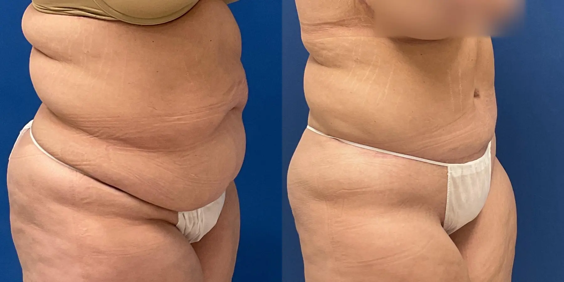 Tummy Tuck: Patient 5 - Before and After 3