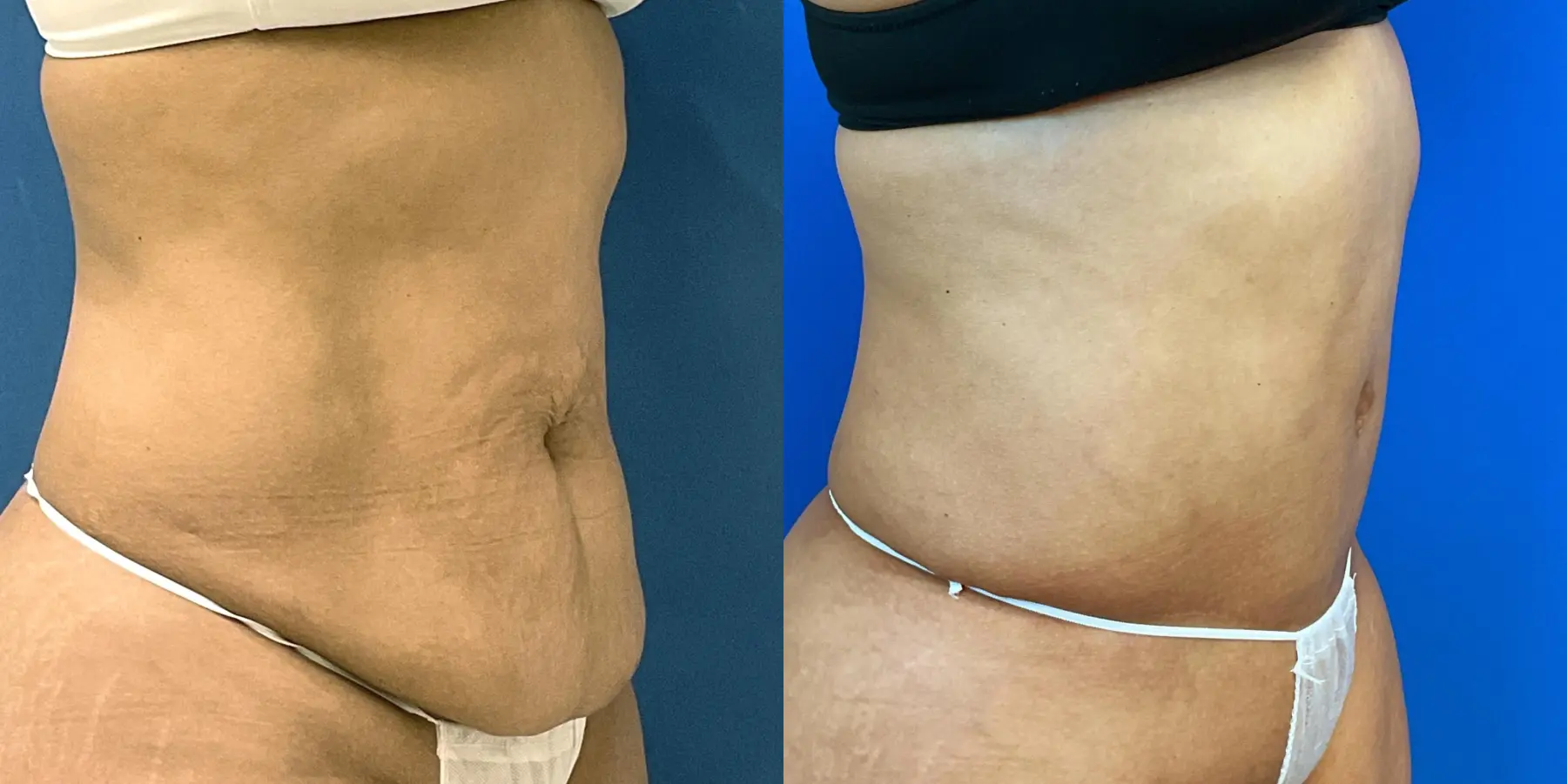 Tummy Tuck: Patient 3 - Before and After 3