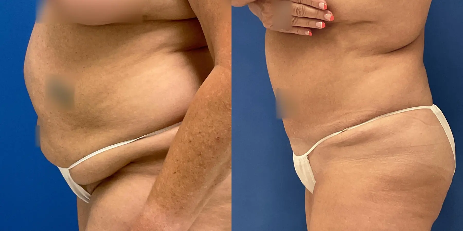 Tummy Tuck: Patient 26 - Before and After 3