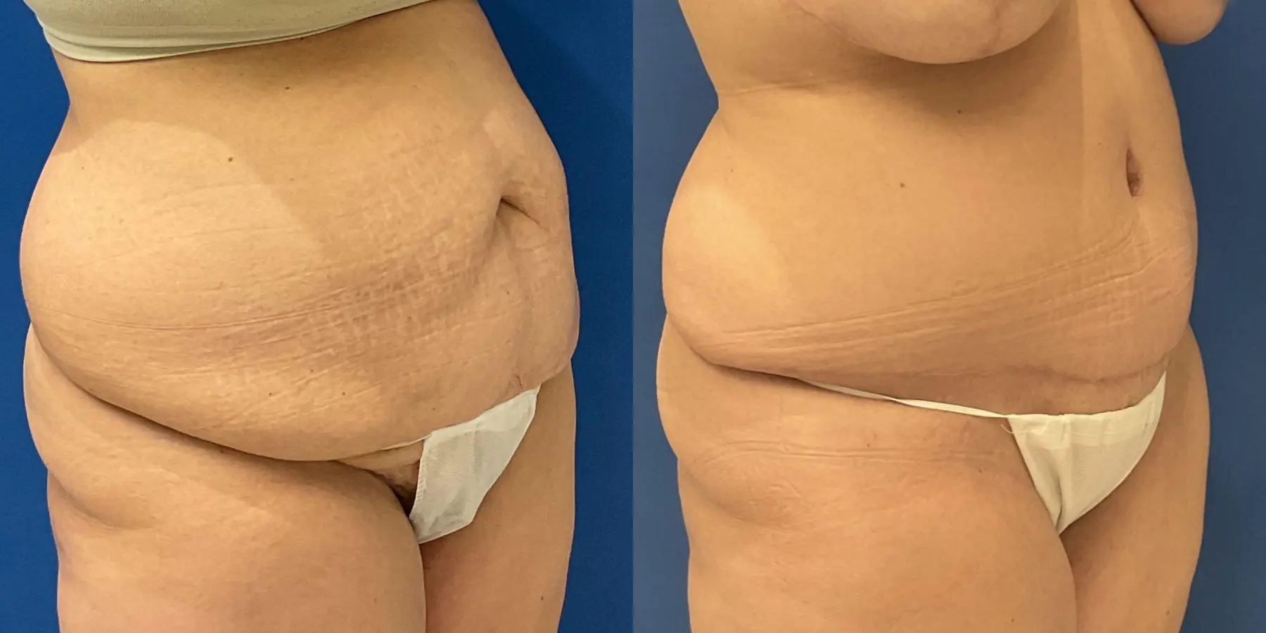 Tummy Tuck: Patient 6 - Before and After 3