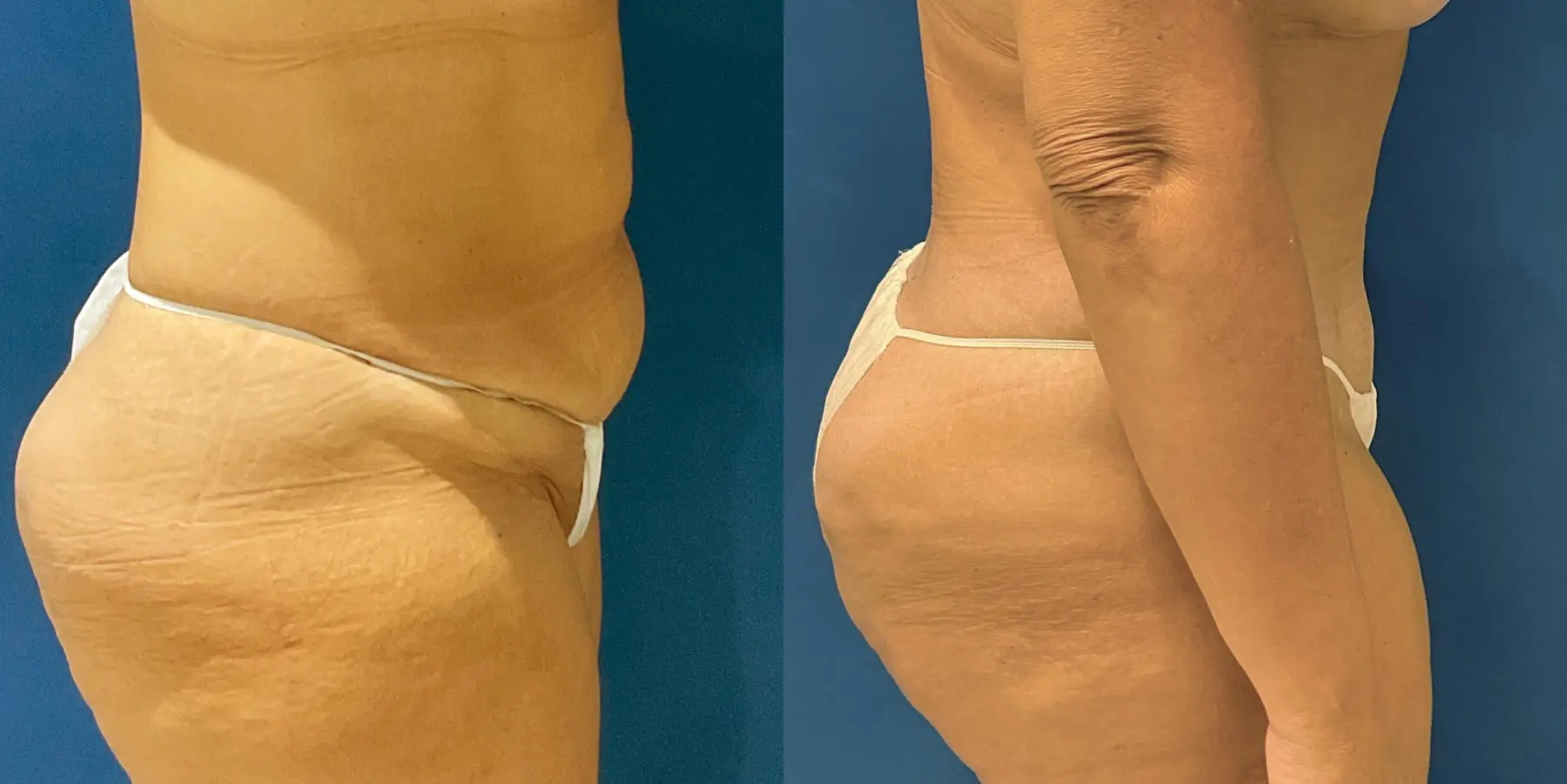 Tummy Tuck: Patient 8 - Before and After 5