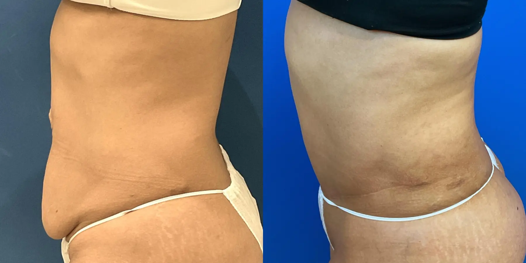 Tummy Tuck: Patient 3 - Before and After 4