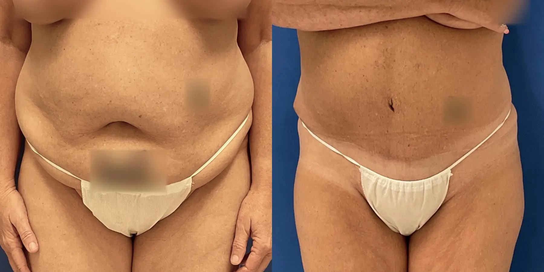 Tummy Tuck: Patient 26 - Before and After 1