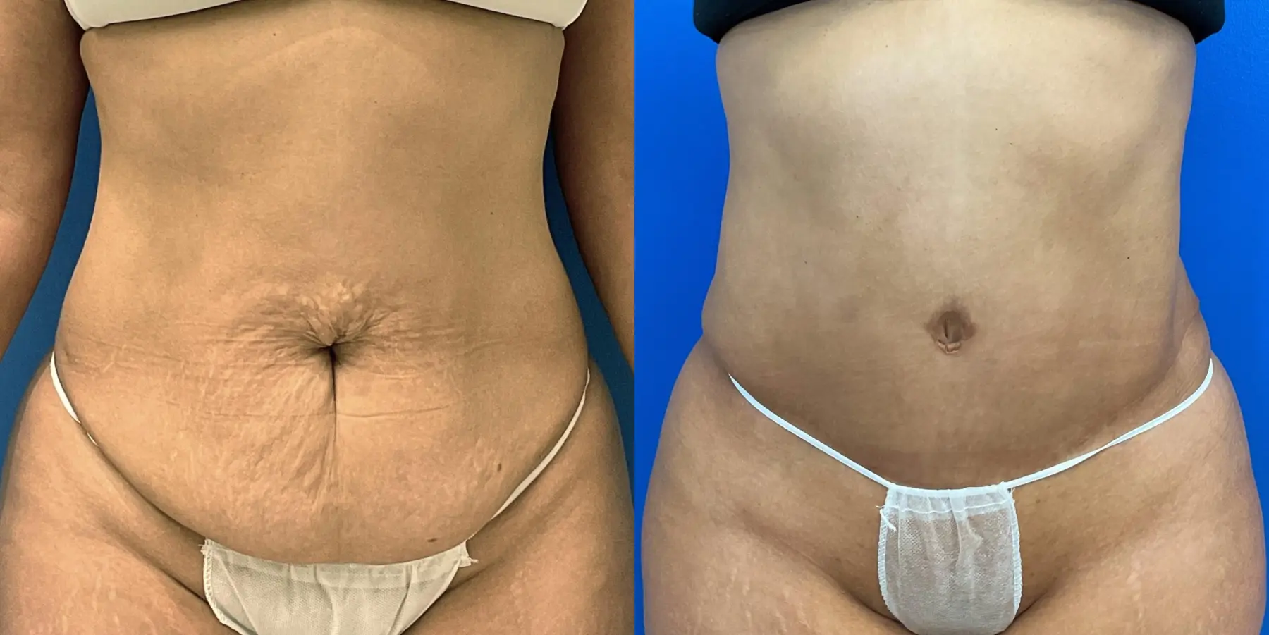 Tummy Tuck: Patient 25 - Before and After 1