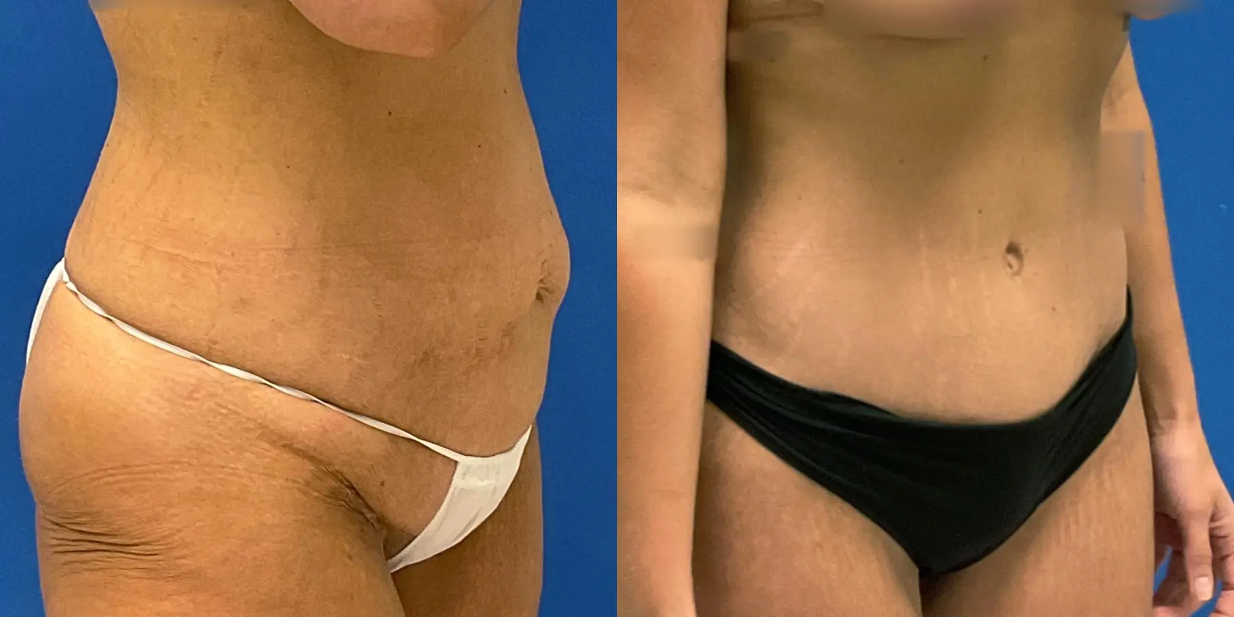 Tummy Tuck: Patient 13 - Before and After 3