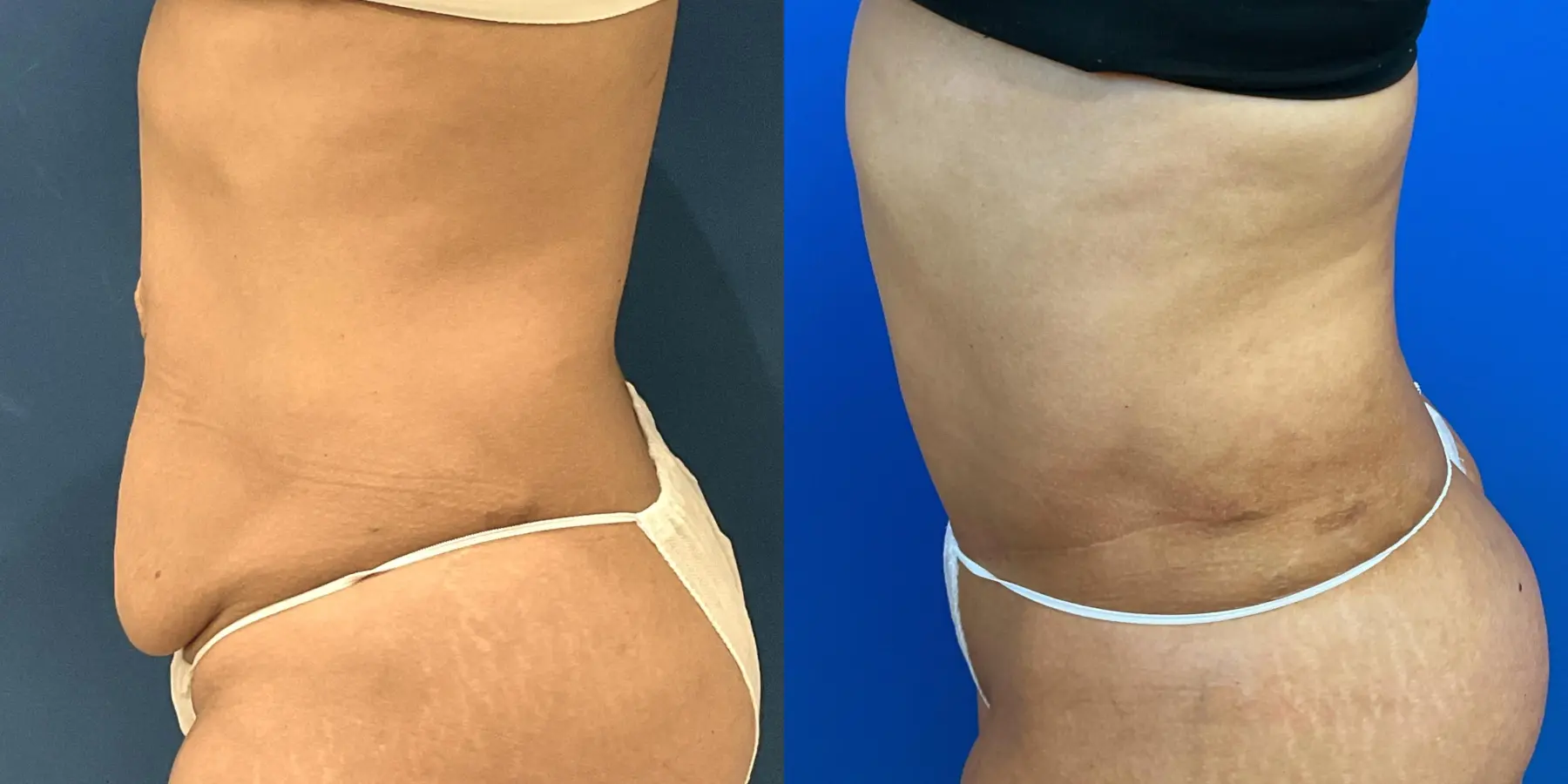 Tummy Tuck: Patient 25 - Before and After 4