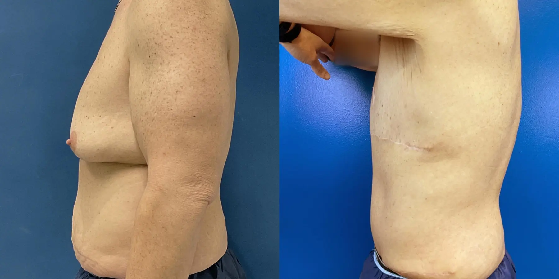 Tummy Tuck For Men: Patient 1 - Before and After 4