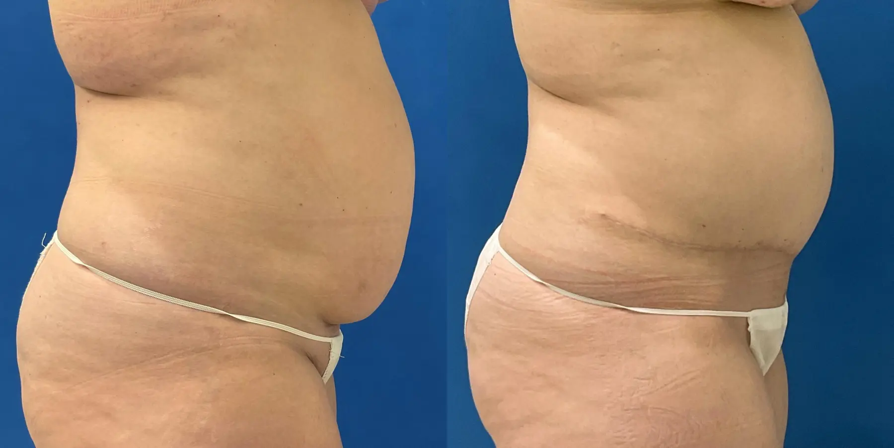 Tummy Tuck: Patient 4 - Before and After 5