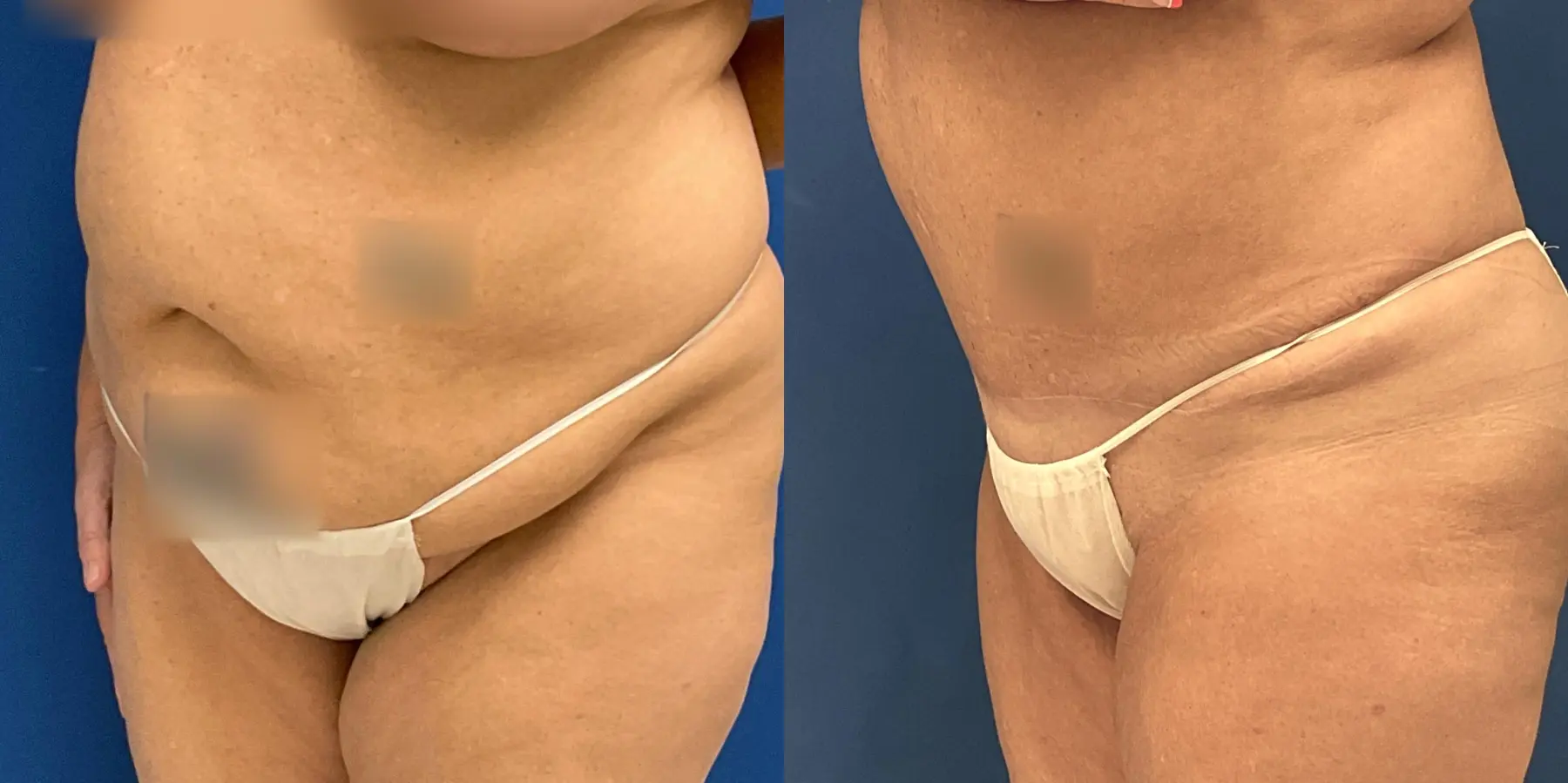 Tummy Tuck: Patient 11 - Before and After 2