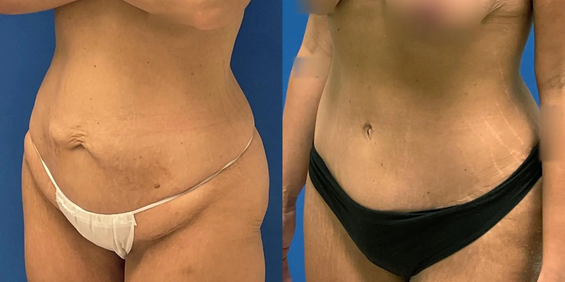 Tummy Tuck: Patient 28 - Before and After 2