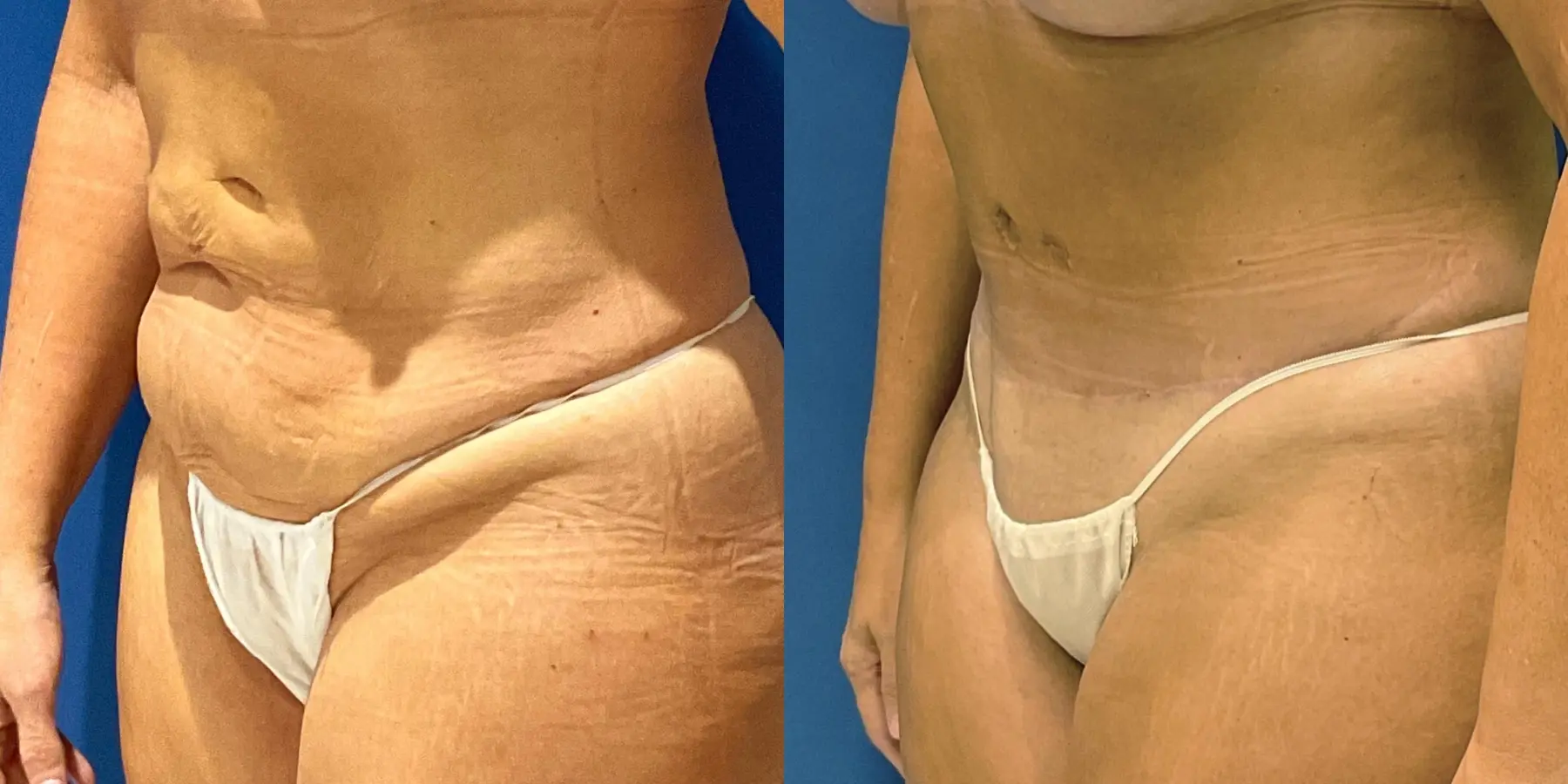 Tummy Tuck: Patient 8 - Before and After 2