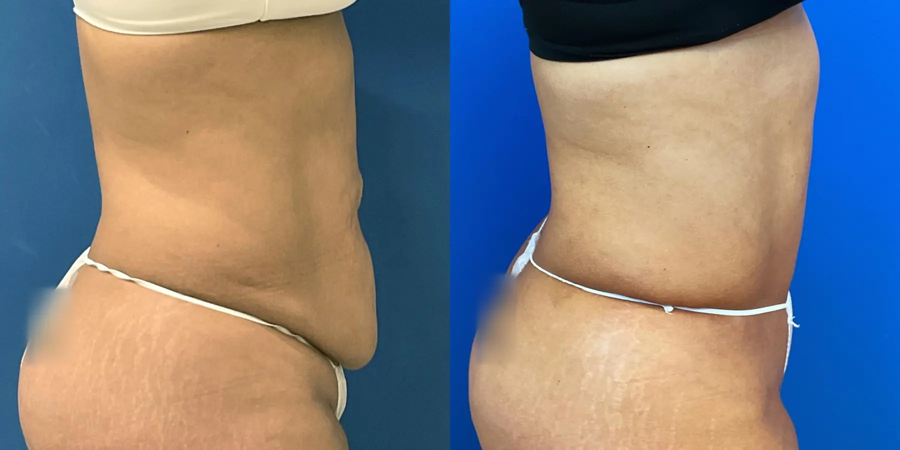 Tummy Tuck: Patient 10 - Before and After 5