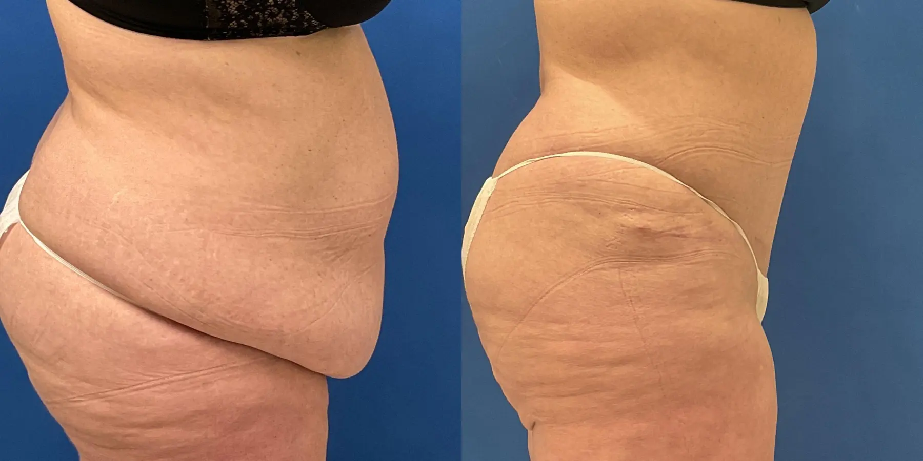 Tummy Tuck: Patient 1 - Before and After 5