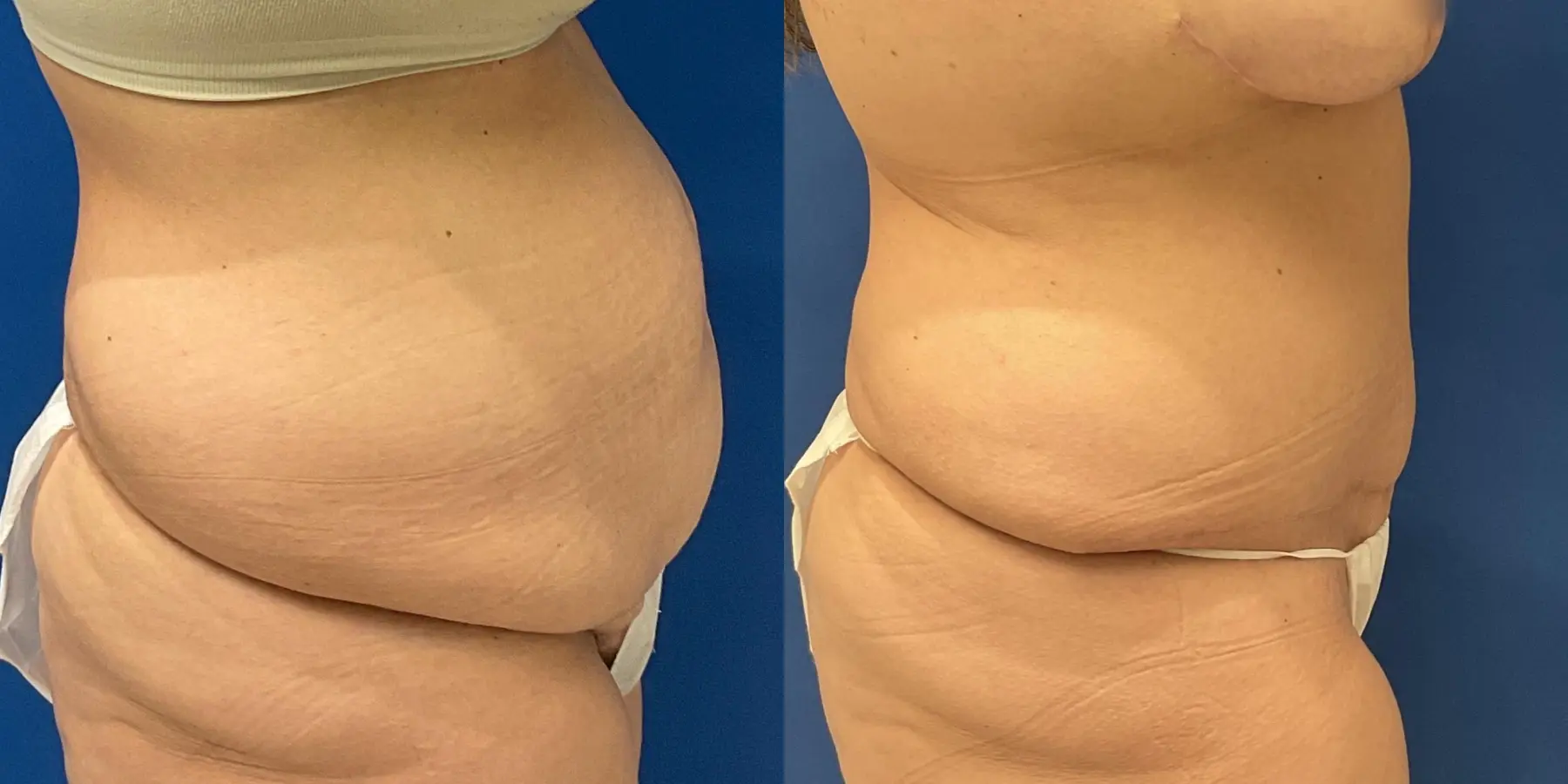 Tummy Tuck: Patient 6 - Before and After 5