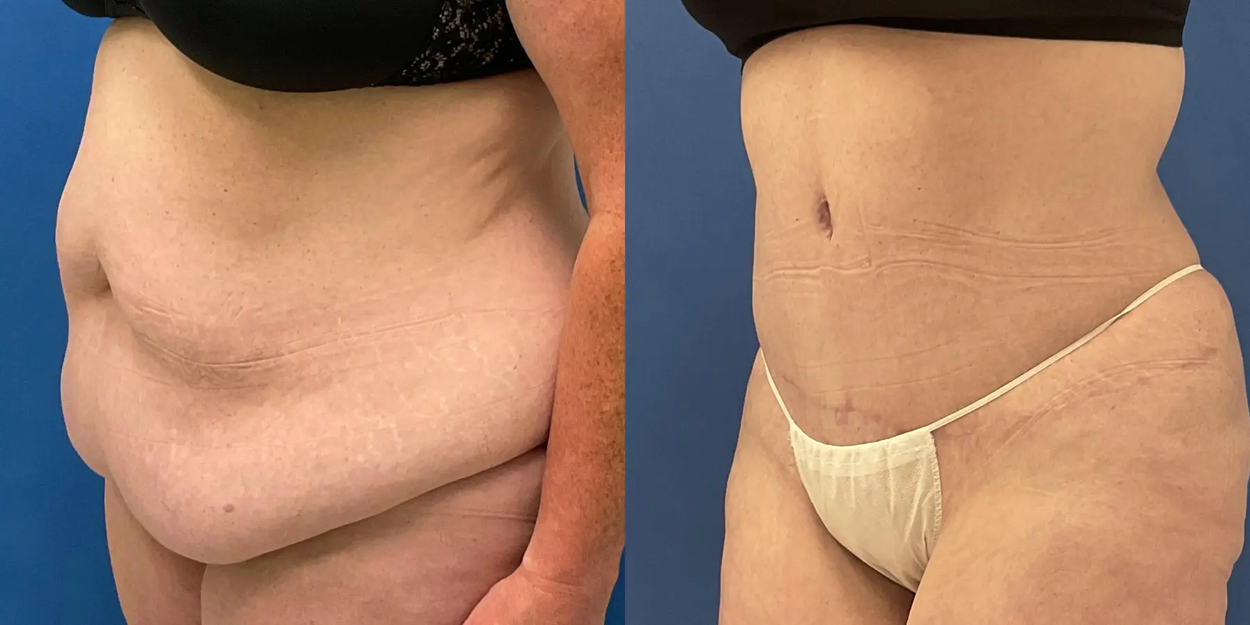 Tummy Tuck: Patient 1 - Before and After 2