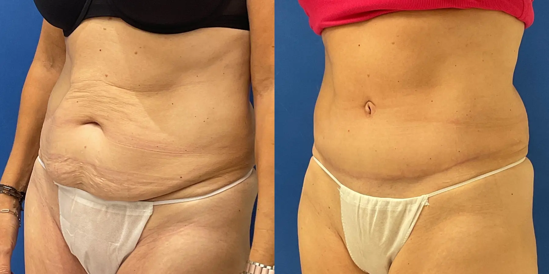 Tummy Tuck: Patient 12 - Before and After 2