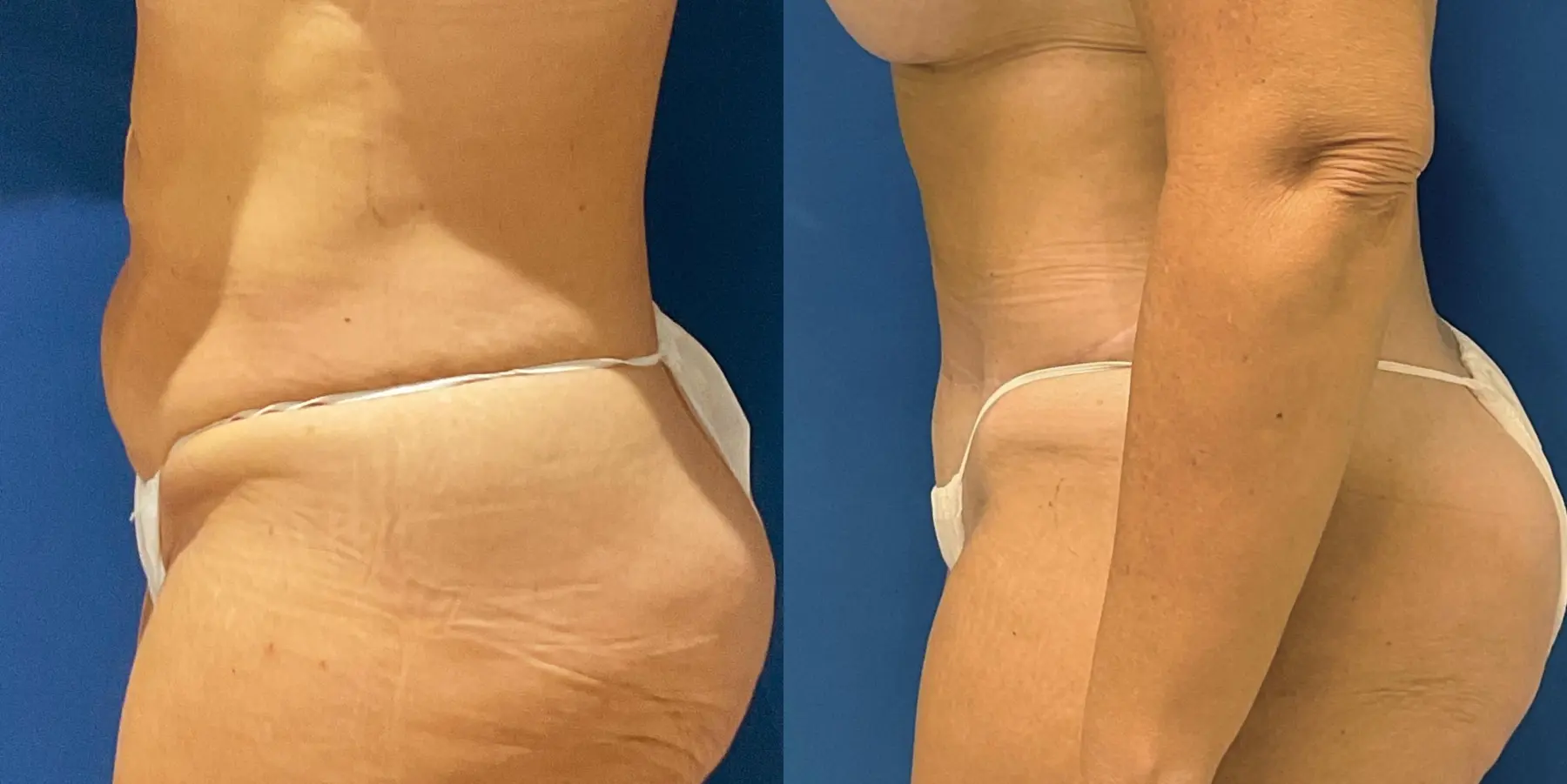 Tummy Tuck: Patient 8 - Before and After 4