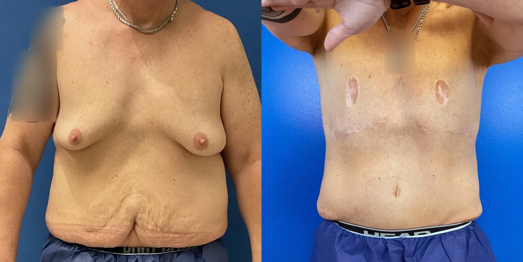 Tummy Tuck For Men: Patient 1 - Before and After 1