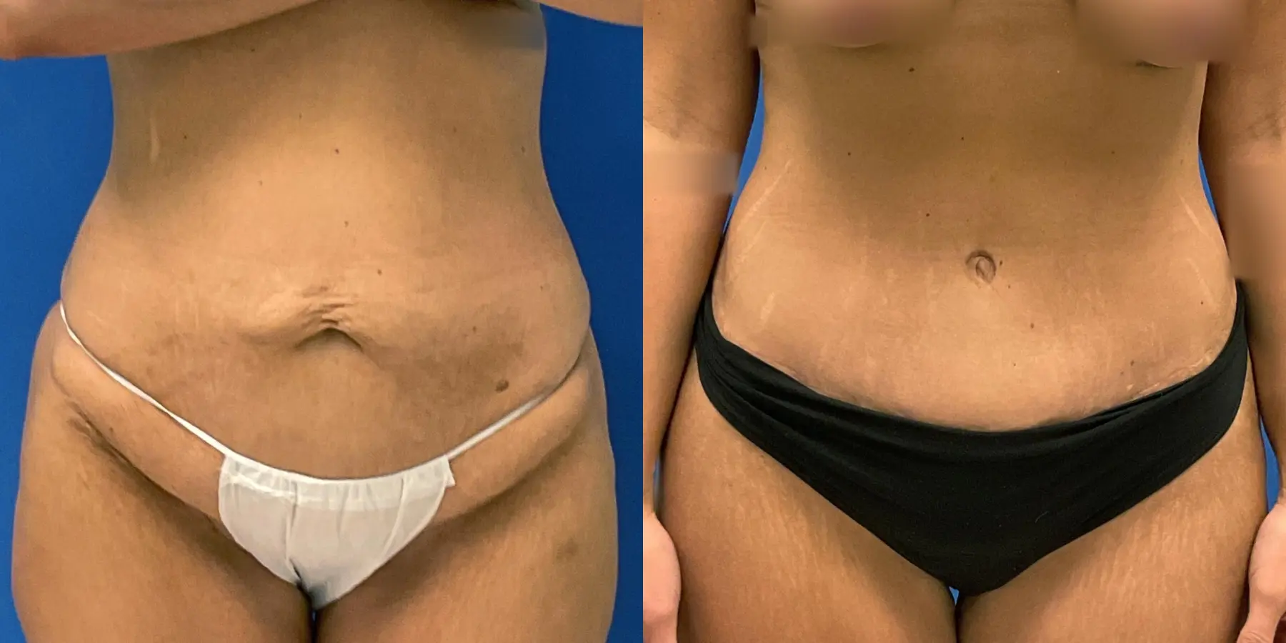 Tummy Tuck: Patient 13 - Before and After 1