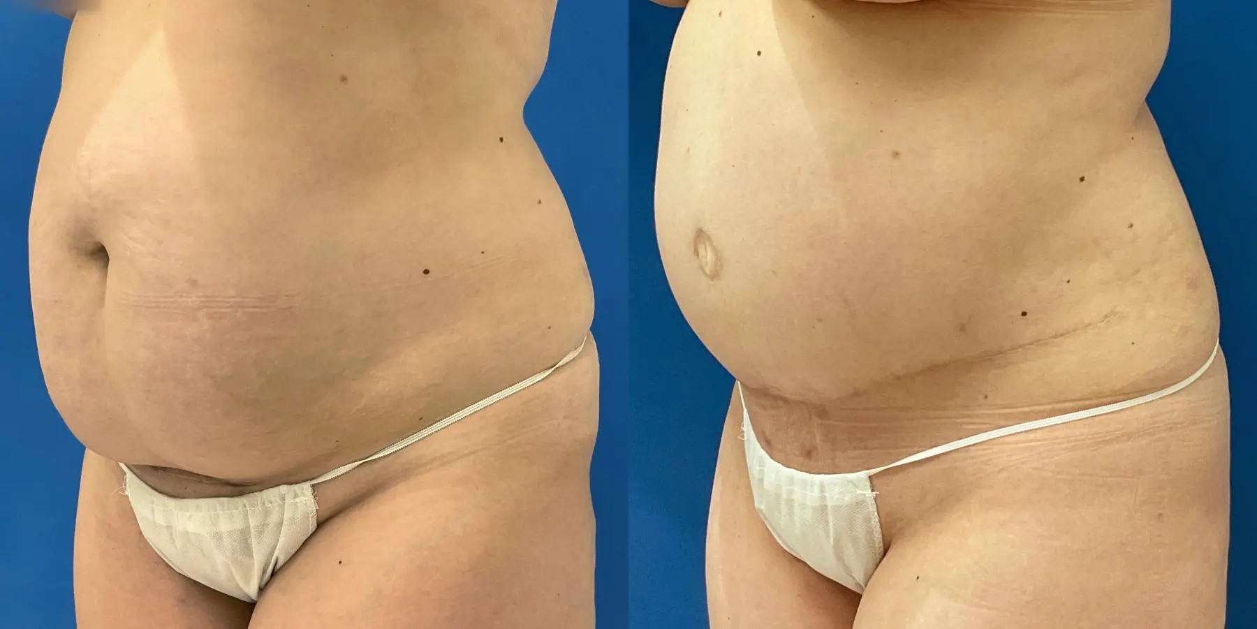 Tummy Tuck: Patient 4 - Before and After 2