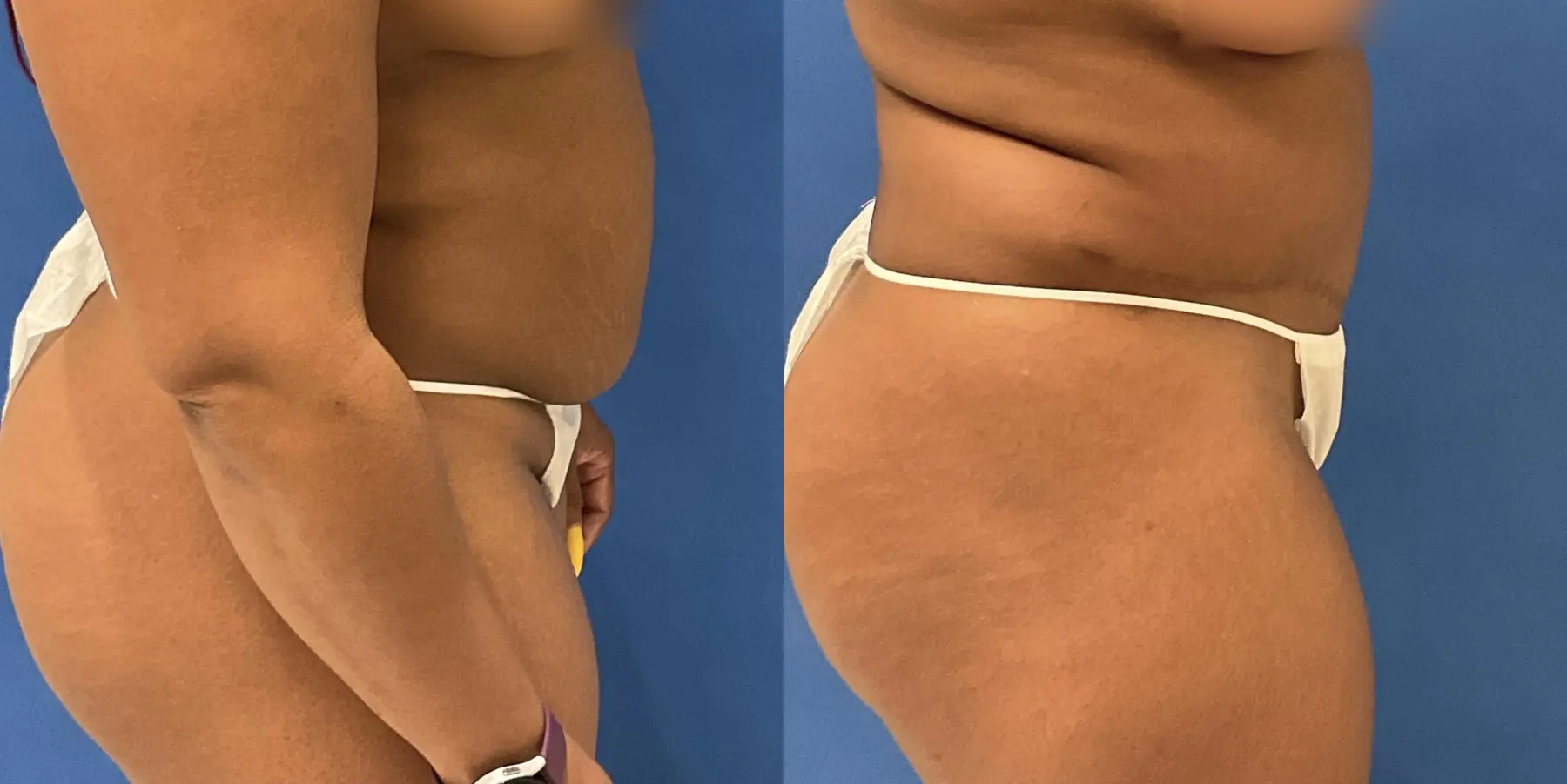 Tummy Tuck: Patient 2 - Before and After 5