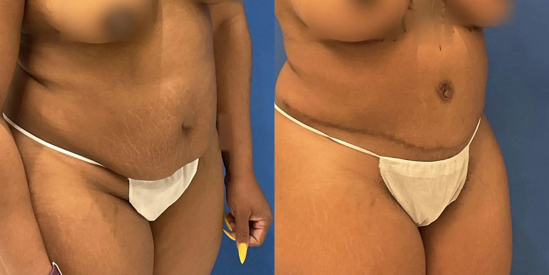 Tummy Tuck: Patient 2 - Before and After 3