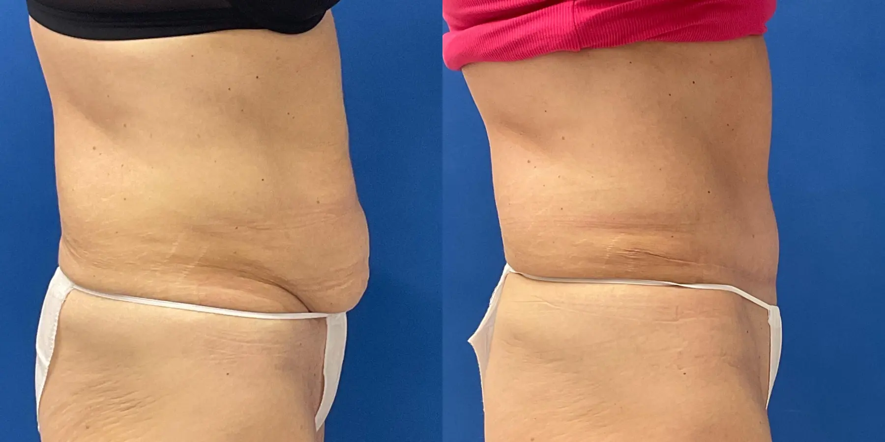 Tummy Tuck: Patient 12 - Before and After 5