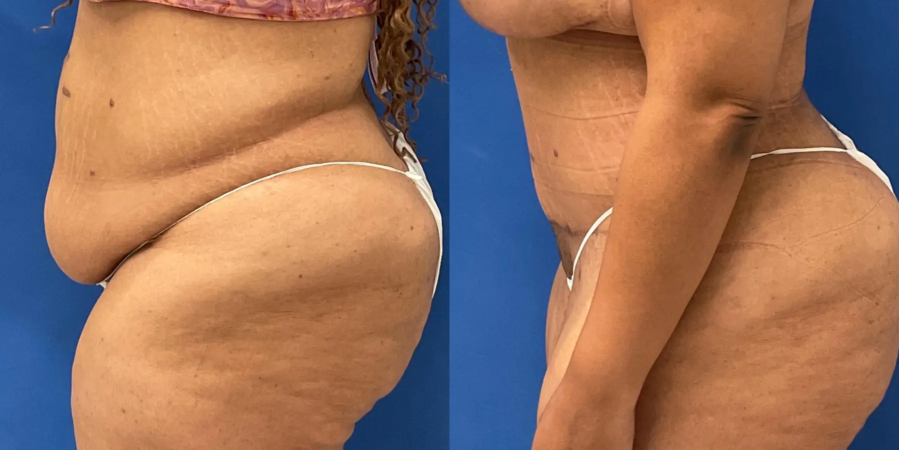 Tummy Tuck: Patient 7 - Before and After 4