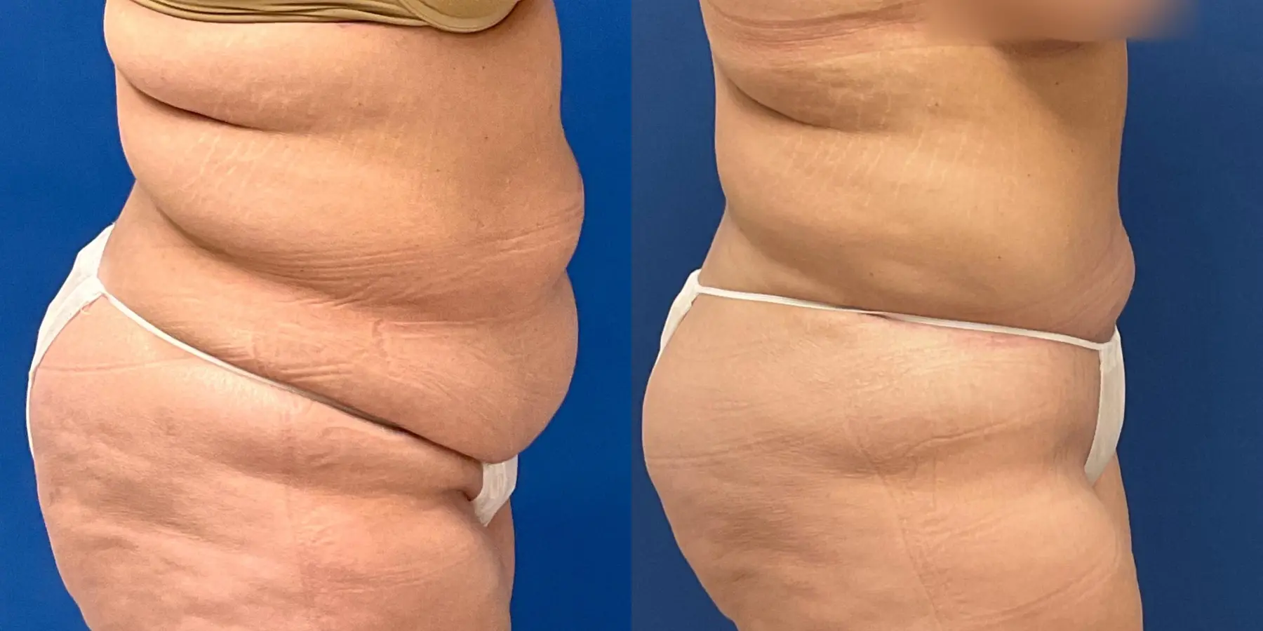 Tummy Tuck: Patient 5 - Before and After 5