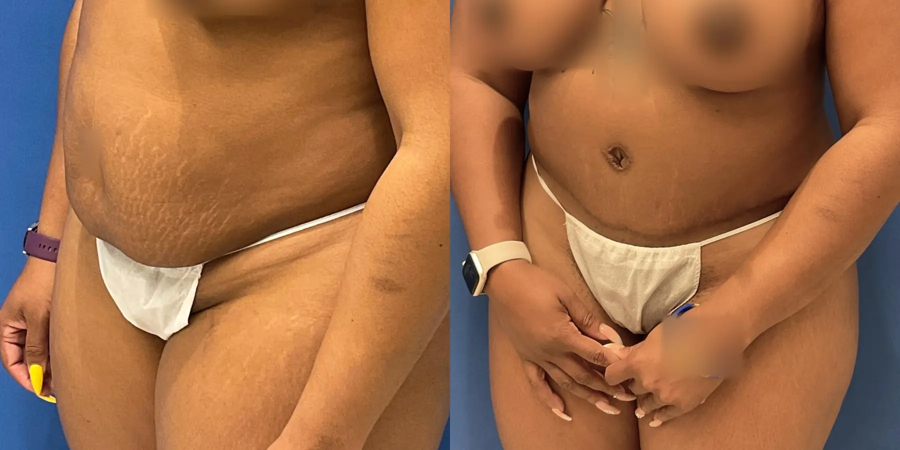 Tummy Tuck: Patient 2 - Before and After 2