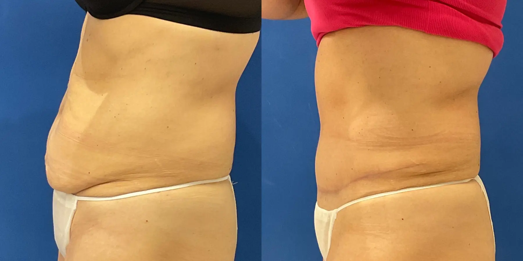 Tummy Tuck: Patient 12 - Before and After 4