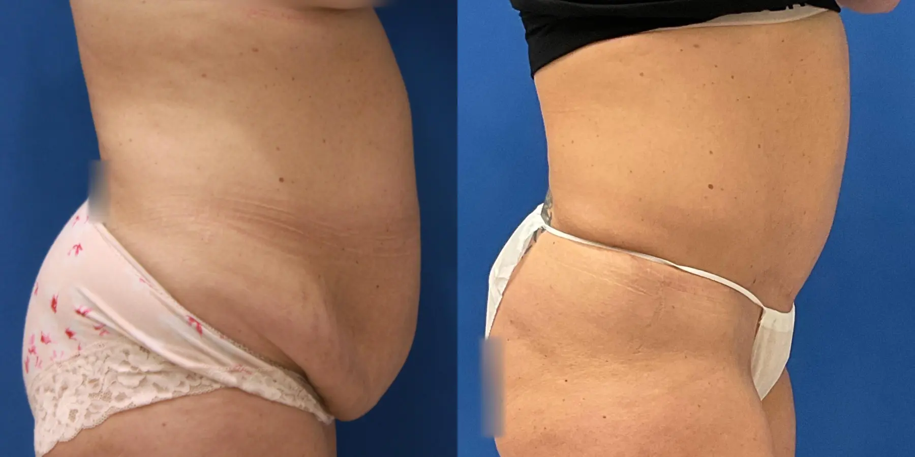 Tummy Tuck: Patient 29 - Before and After 3