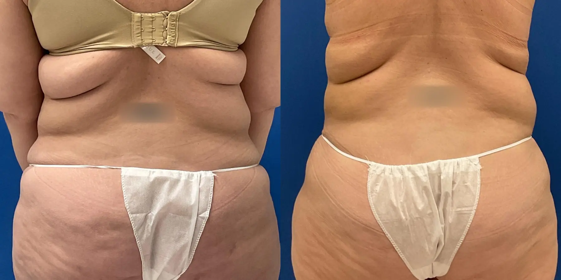 Tummy Tuck: Patient 5 - Before and After 6