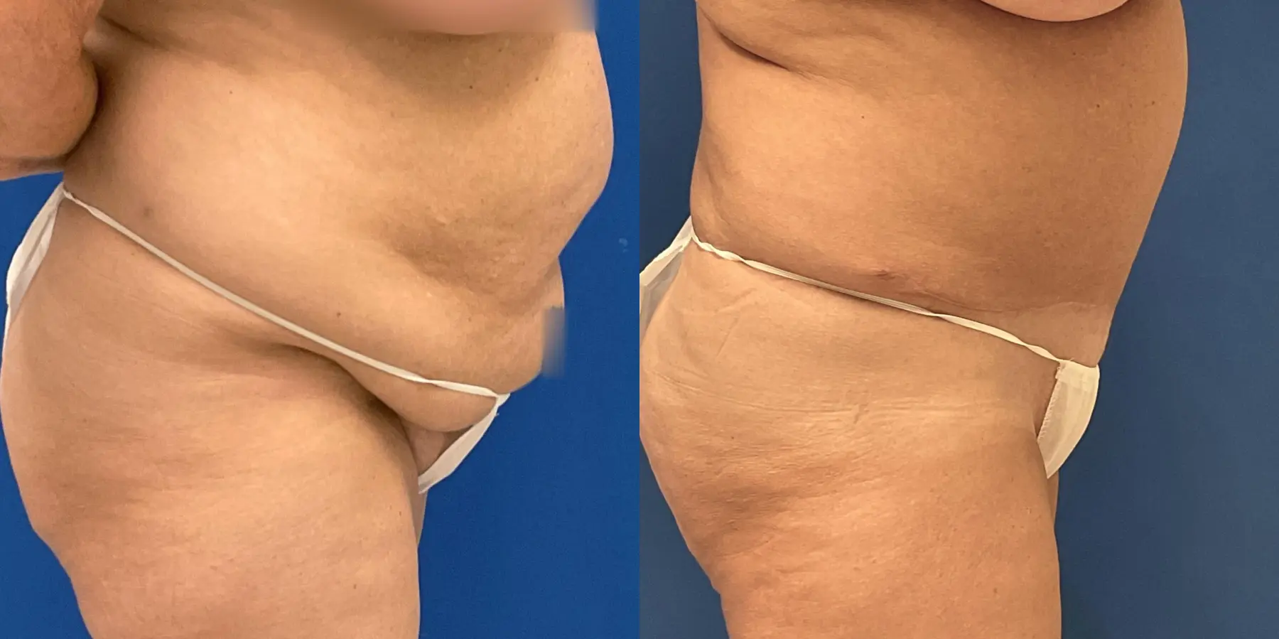 Tummy Tuck: Patient 11 - Before and After 4