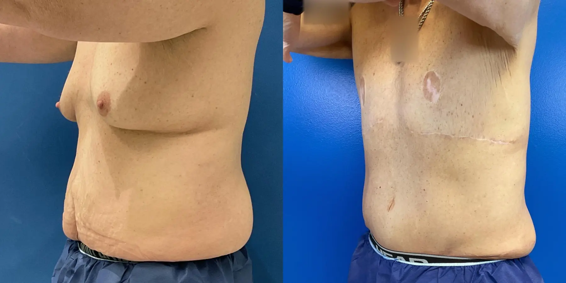 Tummy Tuck For Men: Patient 1 - Before and After 2