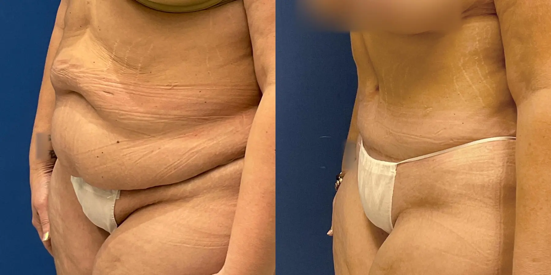 Tummy Tuck: Patient 5 - Before and After 2