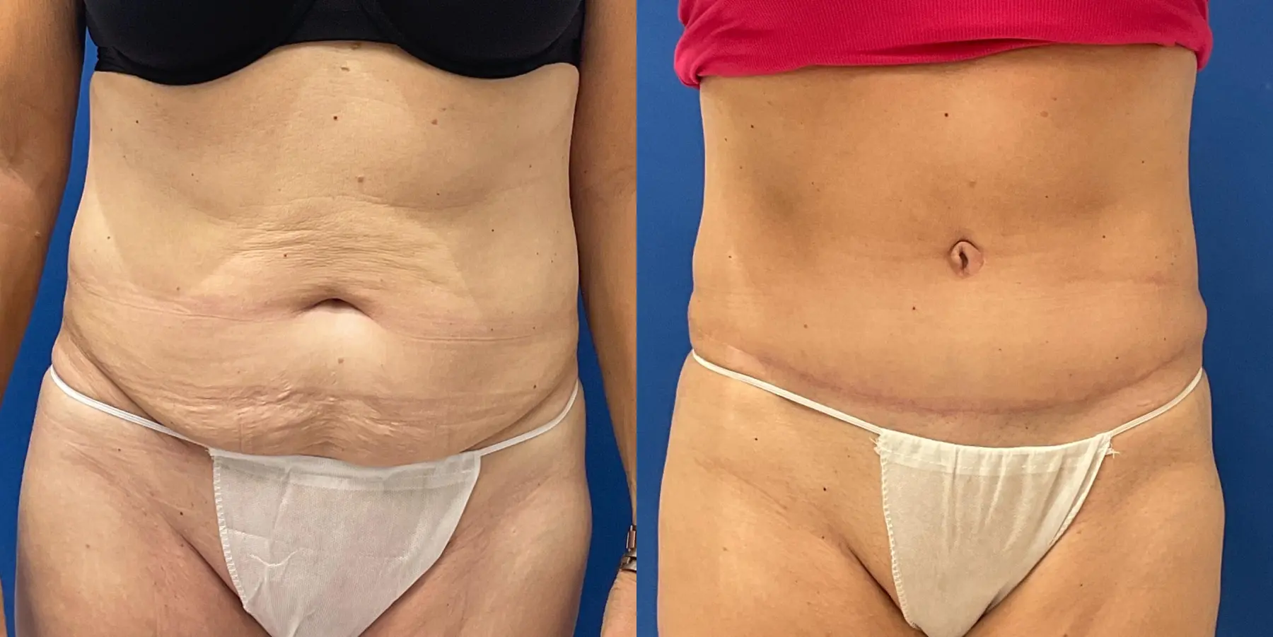 Tummy Tuck: Patient 27 - Before and After 1