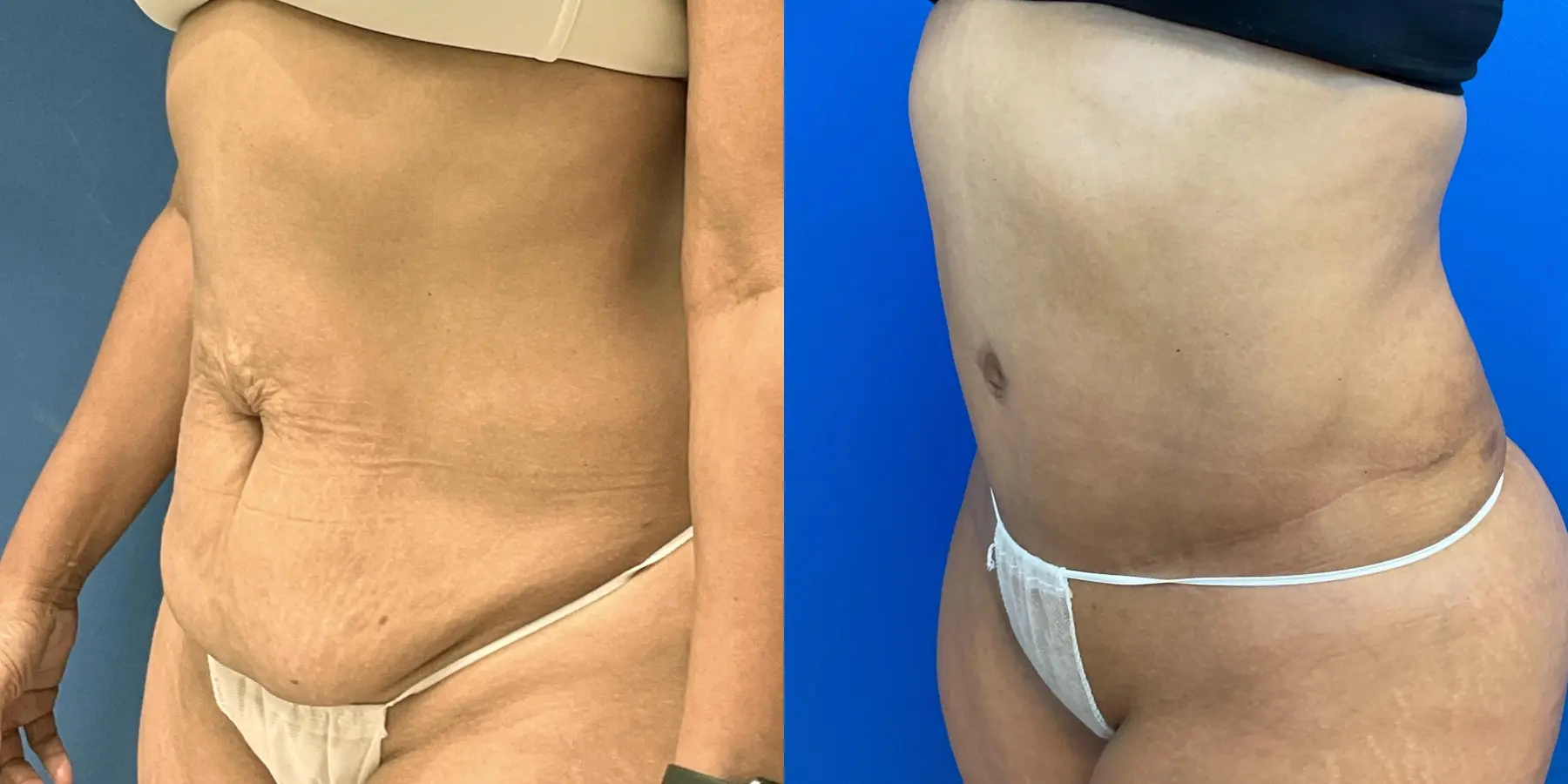 Tummy Tuck: Patient 10 - Before and After 2