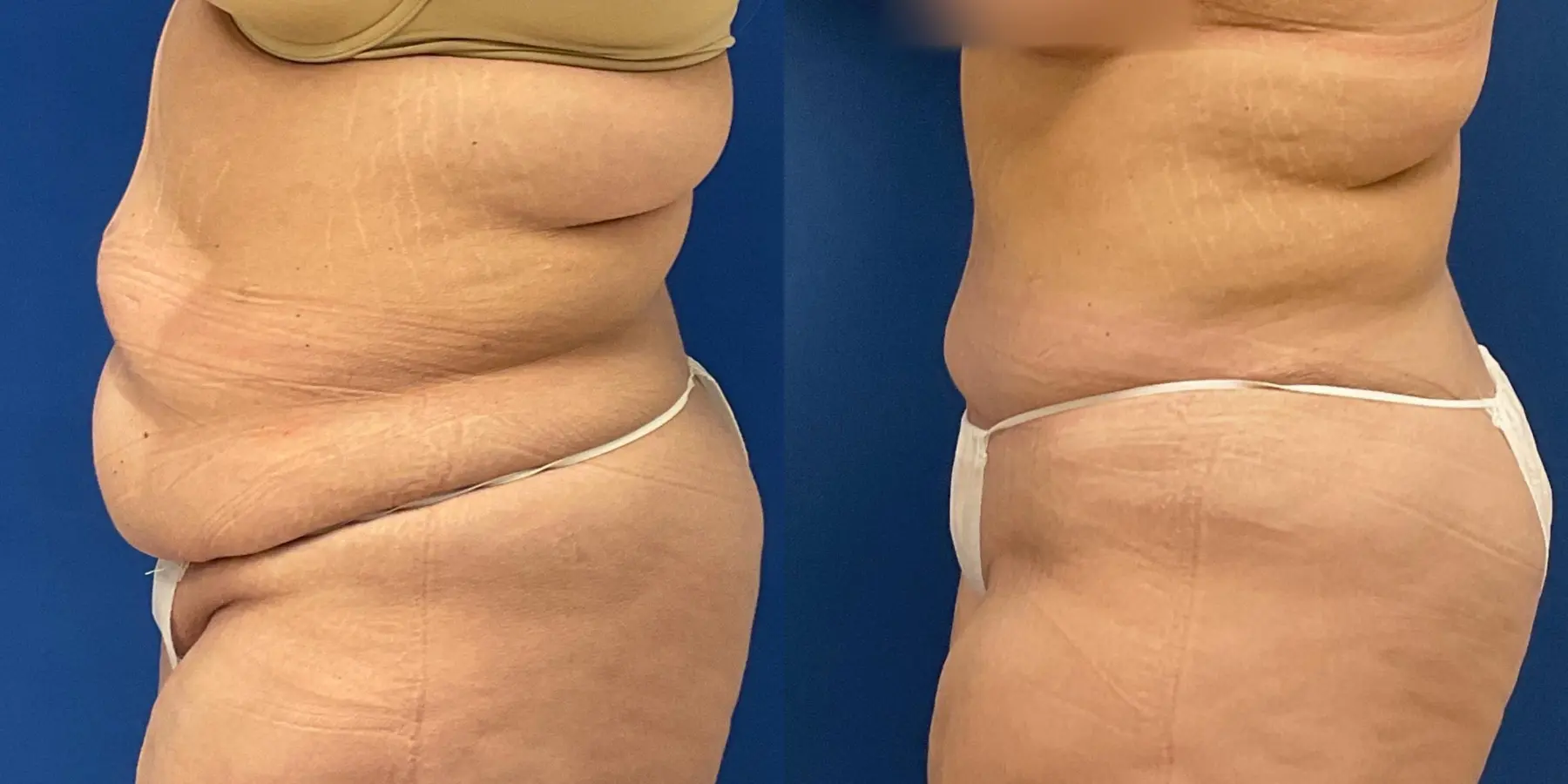 Tummy Tuck: Patient 5 - Before and After 4