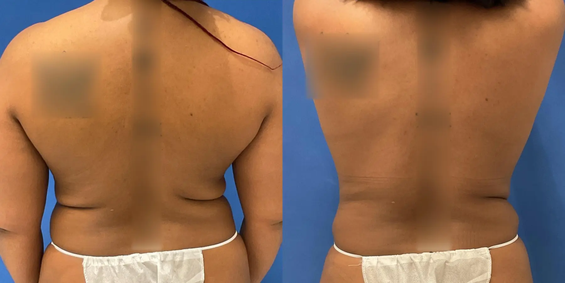 Tummy Tuck: Patient 2 - Before and After 6