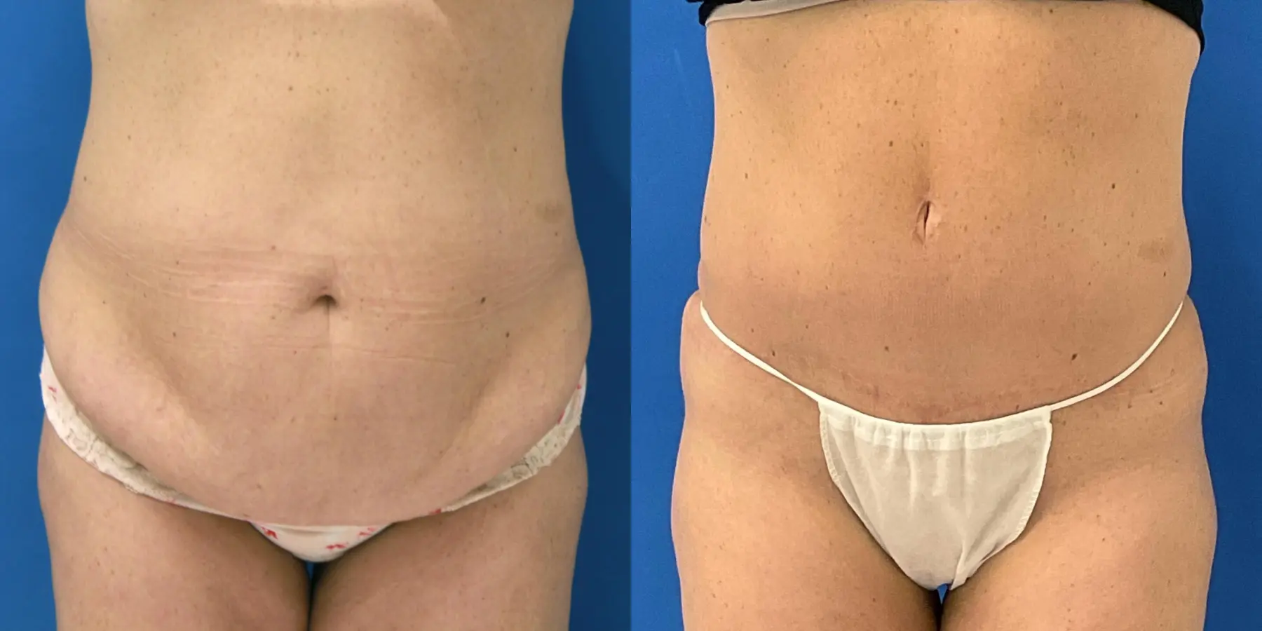 Tummy Tuck: Patient 29 - Before and After 1