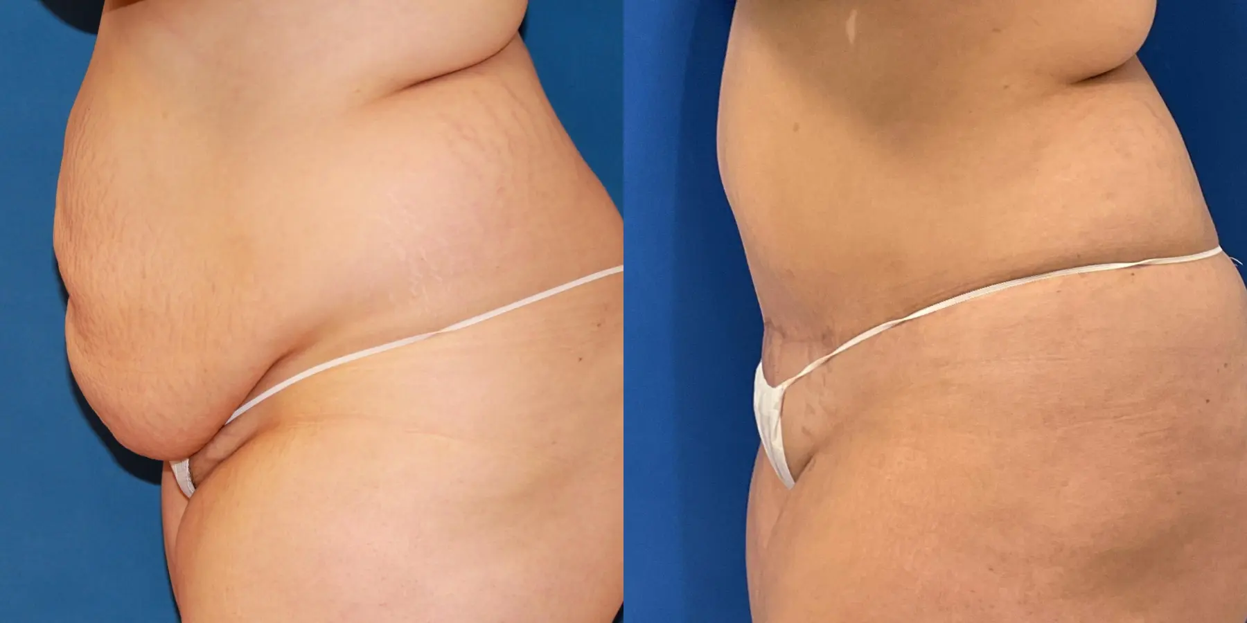 Tummy Tuck: Patient 9 - Before and After 2