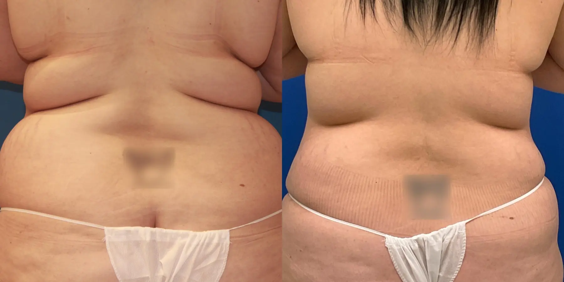 Tummy Tuck: Patient 9 - Before and After 4